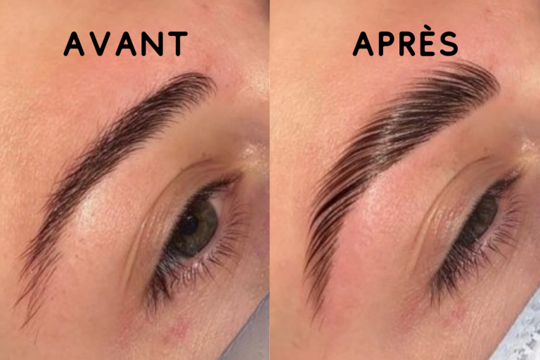 brow lift avant après